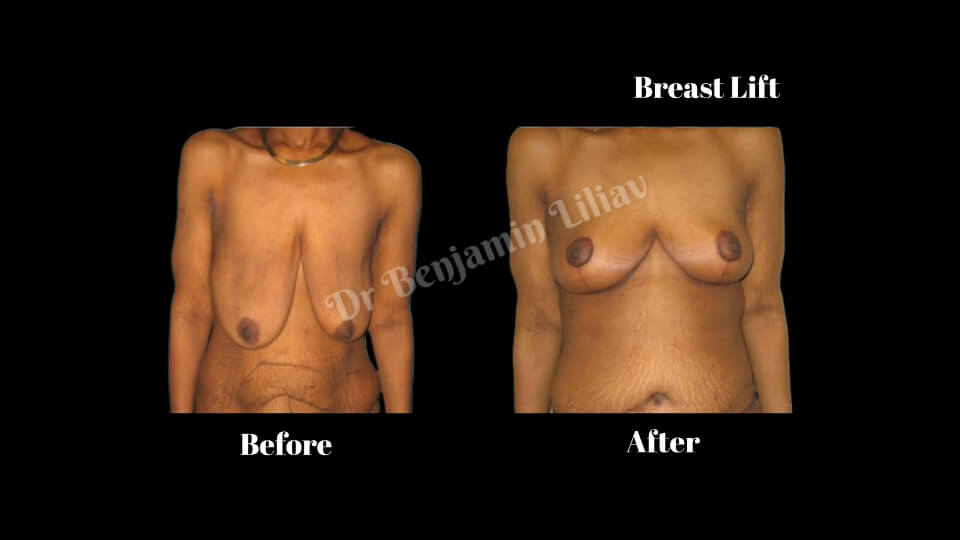 Case--4988 | Before and After Breast