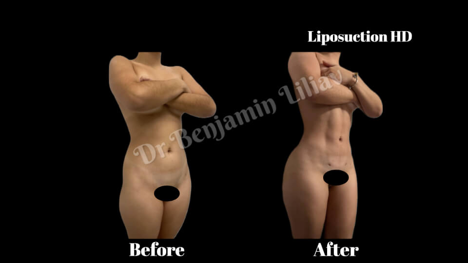 Case--6181 | Before and After Liposuction HD