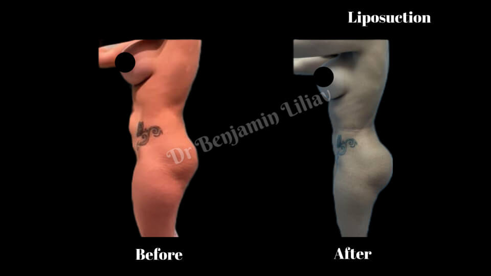 Case--6097 | Before and After Liposuction