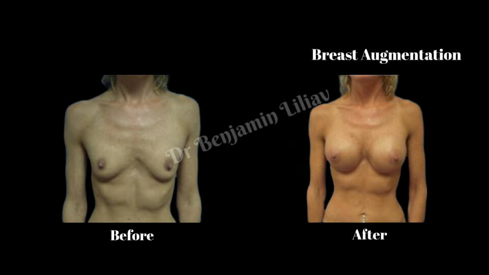 Case--9072 | Before and After Breast Augmentation