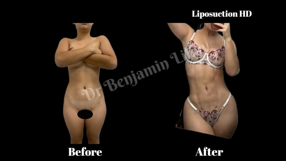 Case--1137 | Before and After Liposuction HD