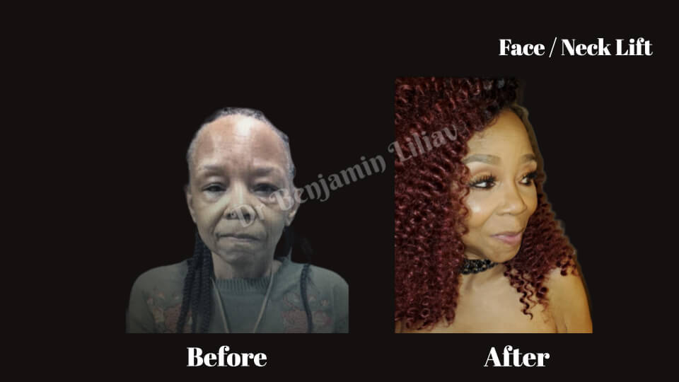 Case--2737 | Before and After Face