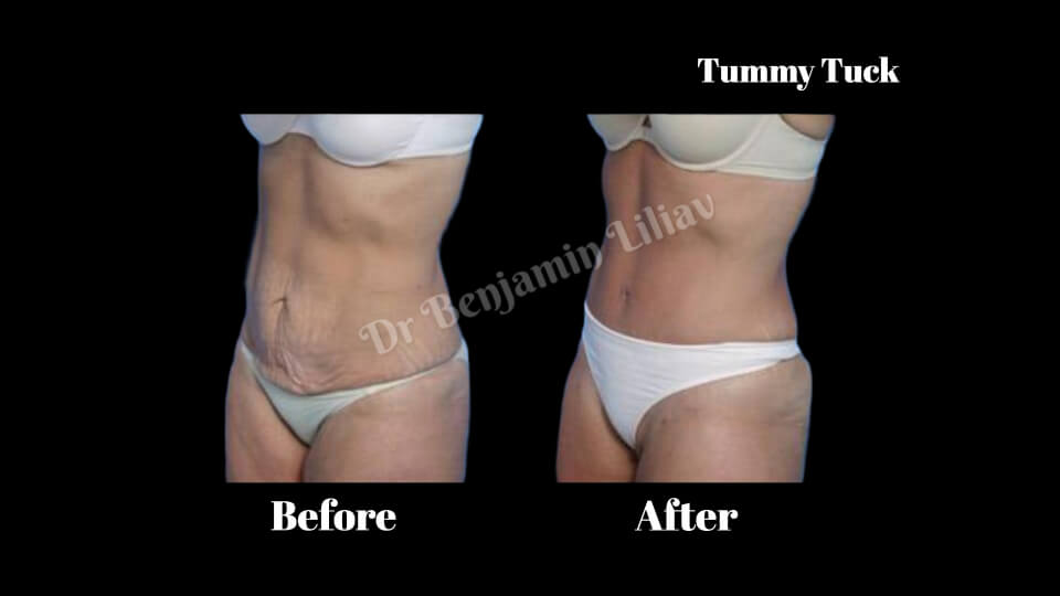 Case--9593 | Before and After Body