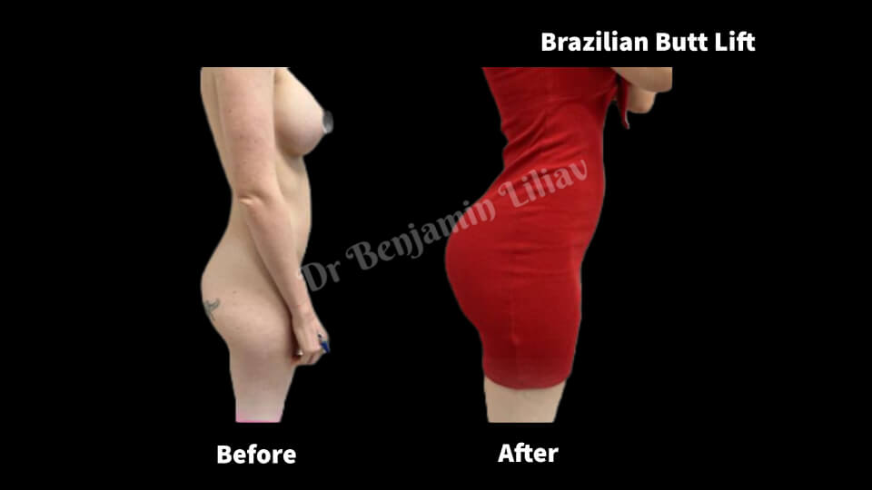 Case--1842 | Before and After BBL