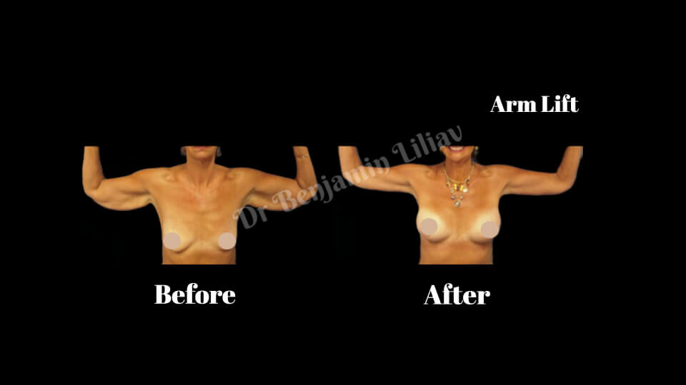 Case--9472 | Before and After Arm Lift