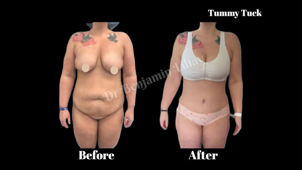 Case--3229 | Before and After Body