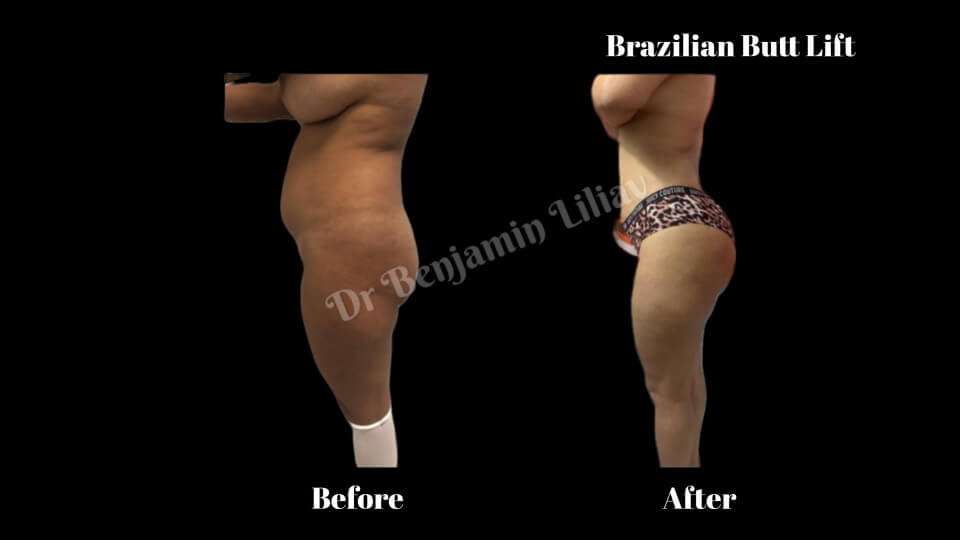 Case--1475 | Before and After BBL