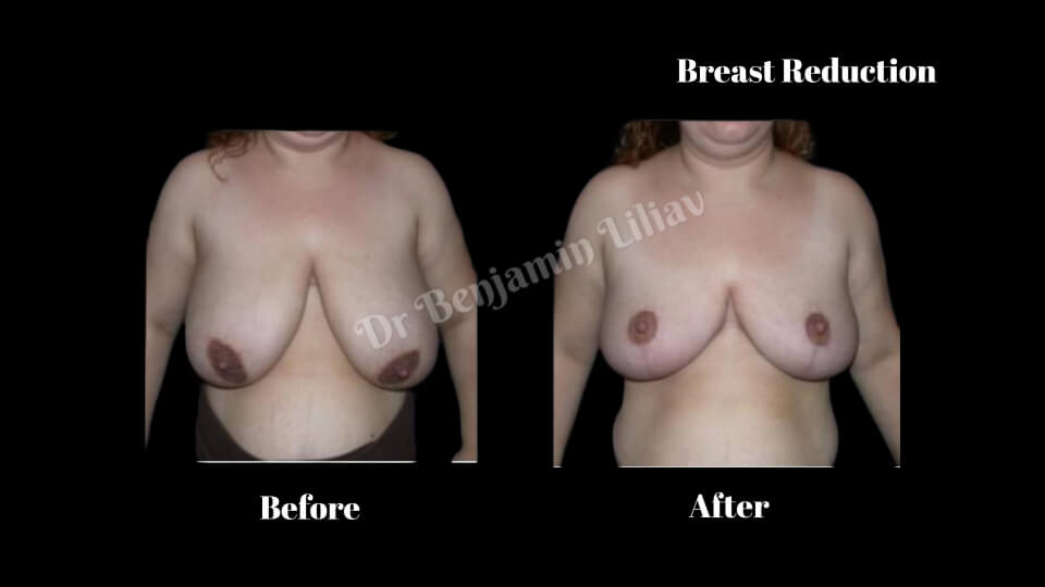 Case--7660 | Before and After Breast