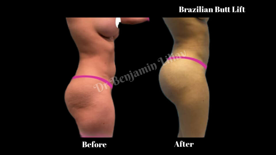 Case--1658 | Before and After BBL