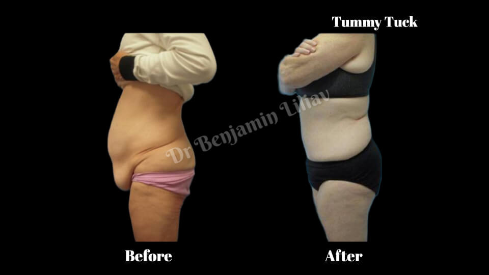 Case--6796 | Before and After Body