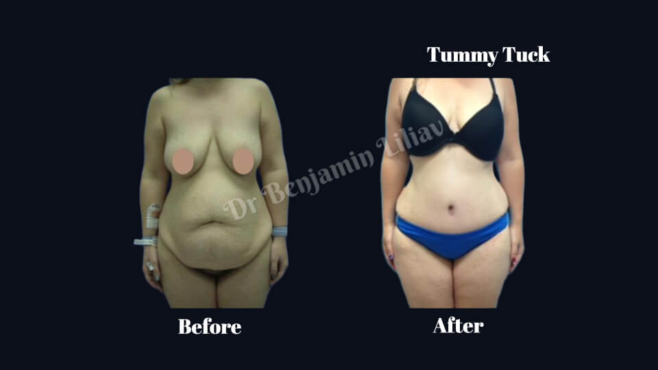 Case--3345 | Before and After Body