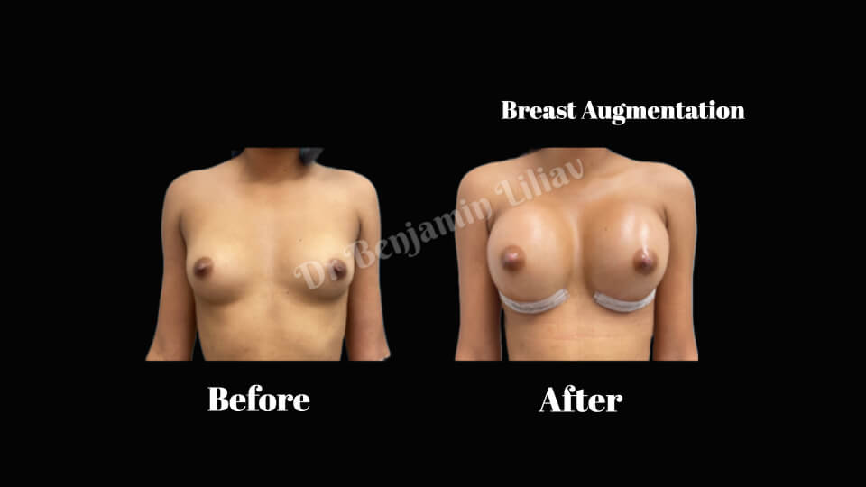 Case--4807 | Before and After Breast Augmentation