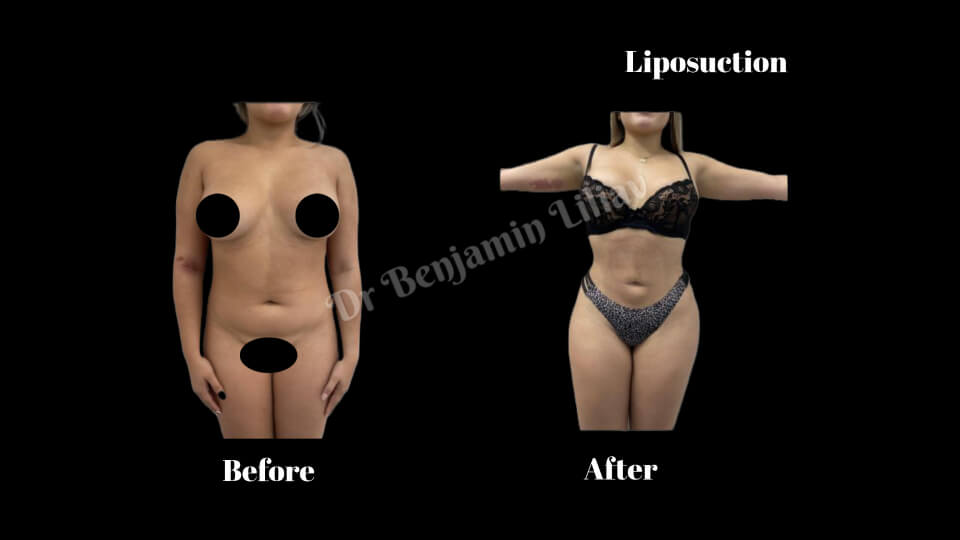 Case--8961 | Before and After Liposuction