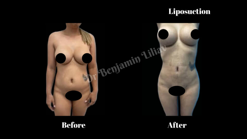 Case--1076 | Before and After Liposuction