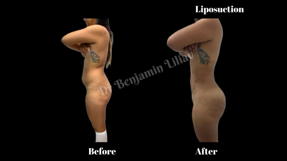 Case--3785 | Before and After Liposuction