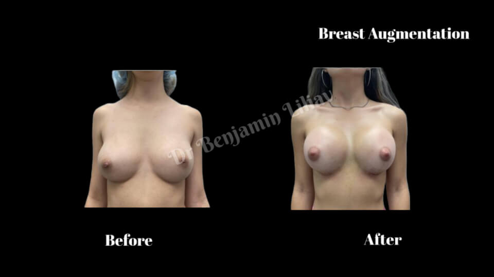 Case--3019 | Before and After Breast Augmentation