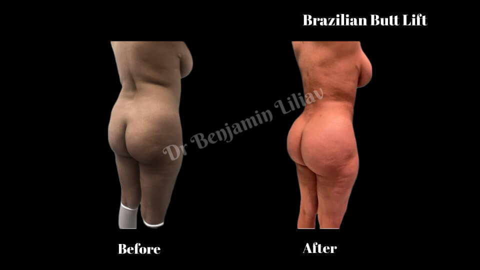 Case--9870 | Before and After BBL