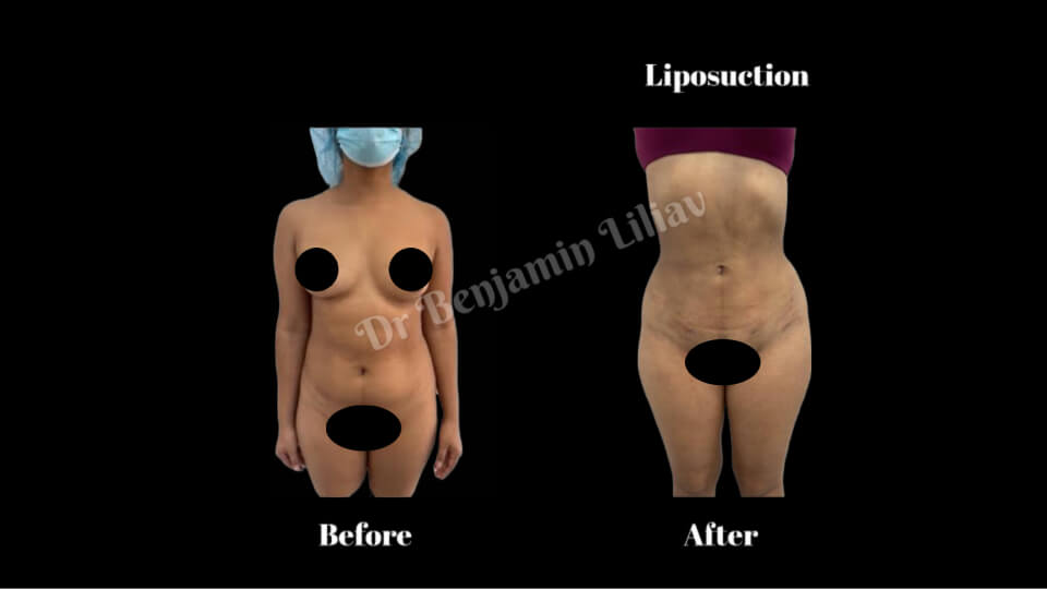 Case--5856 | Before and After Liposuction