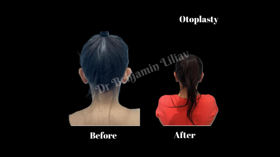 Case--8939 | Before and After Otoplasty