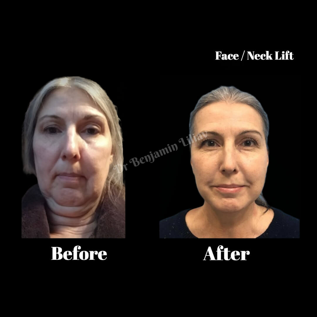 Case--5551 | Before and After Face