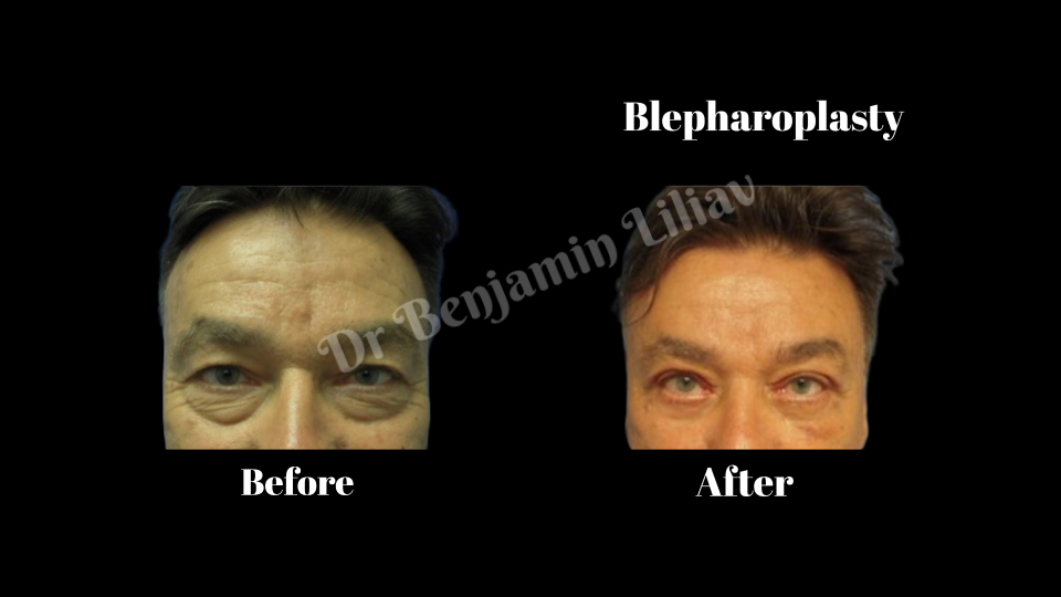 Case--3749 | Before and After Face