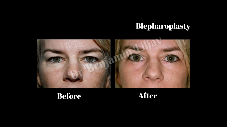 Case--9252 | Before and After Face