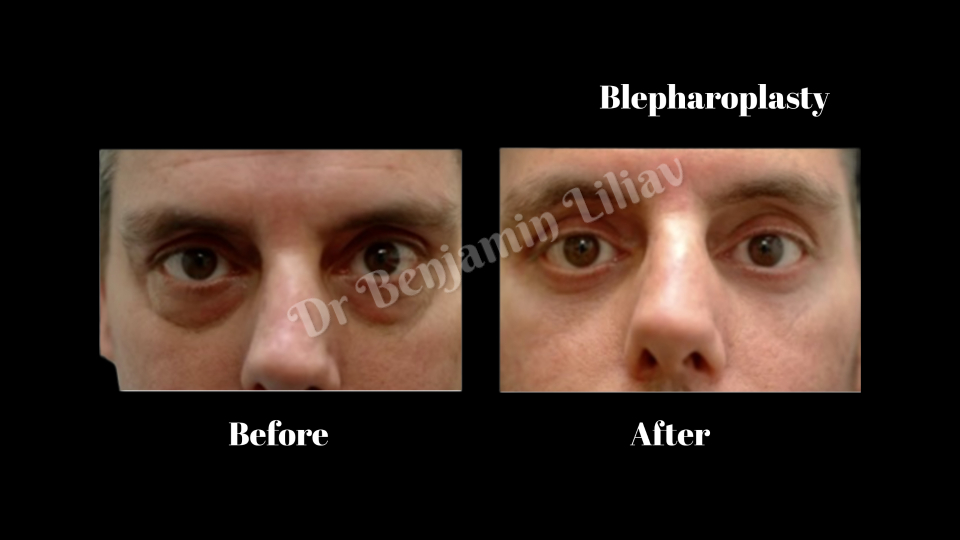 Case--3092 | Before and After Face