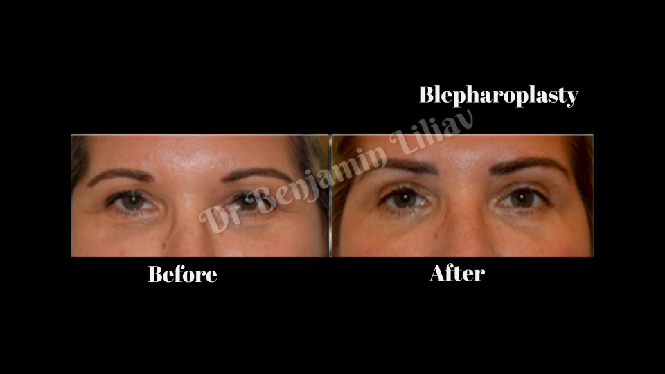 Case--5874 | Before and After Face