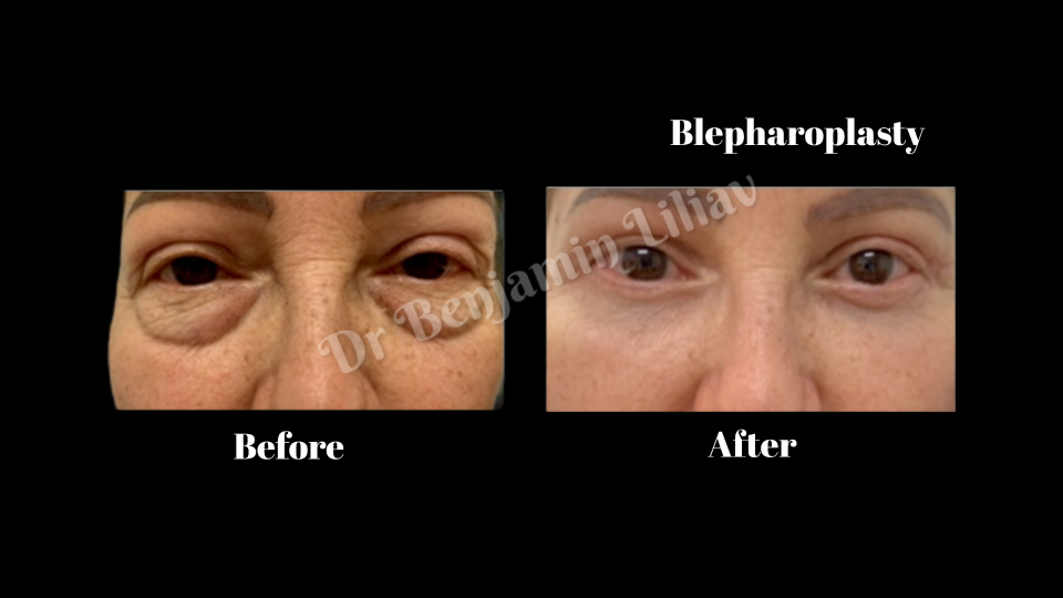 Case--1070 | Before and After Face