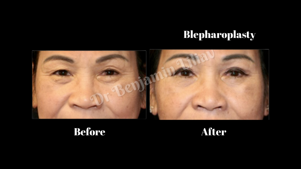 Case--4338 | Before and After Face