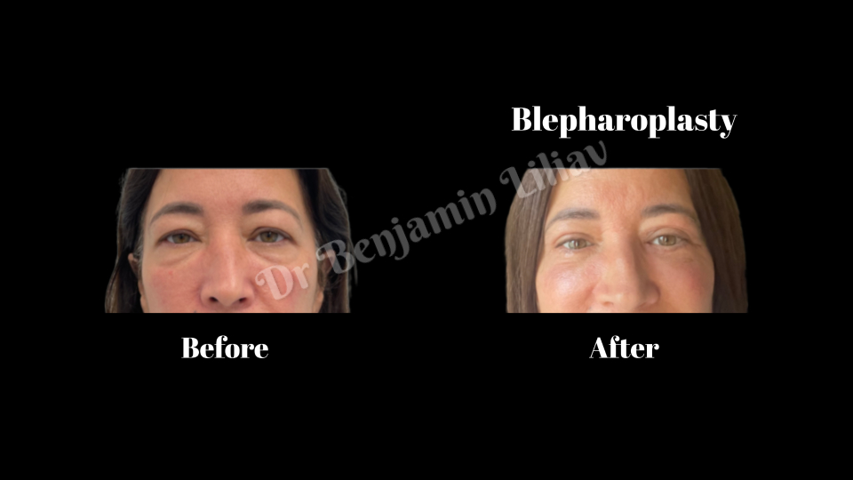 Case--1315 | Before and After Face