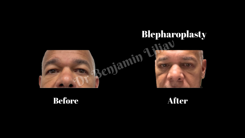 Case--4526 | Before and After Face