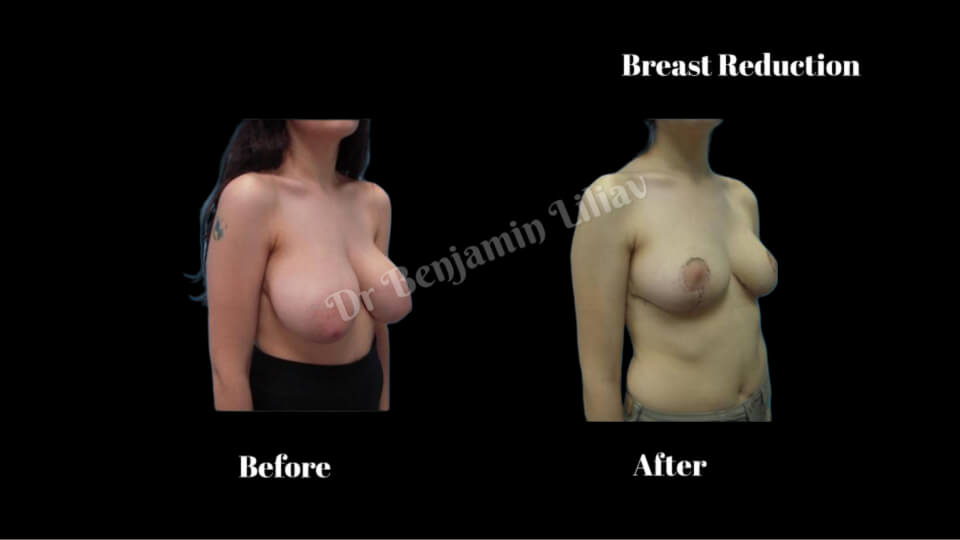Case--3228 | Before and After Breast