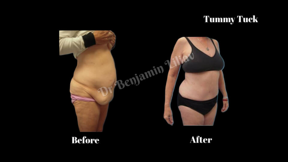 Case--6480 | Before and After Tummy Tuck