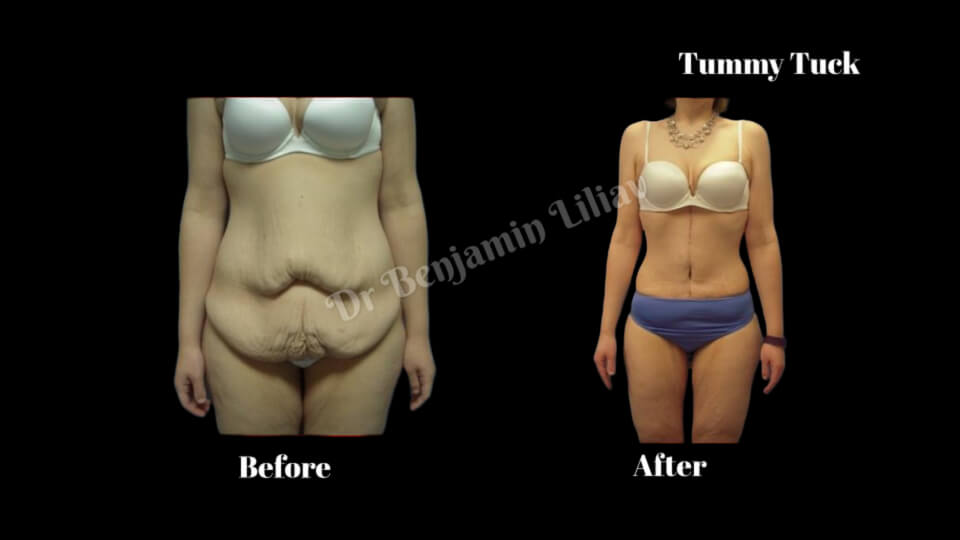 Case--8104 | Before and After Tummy Tuck