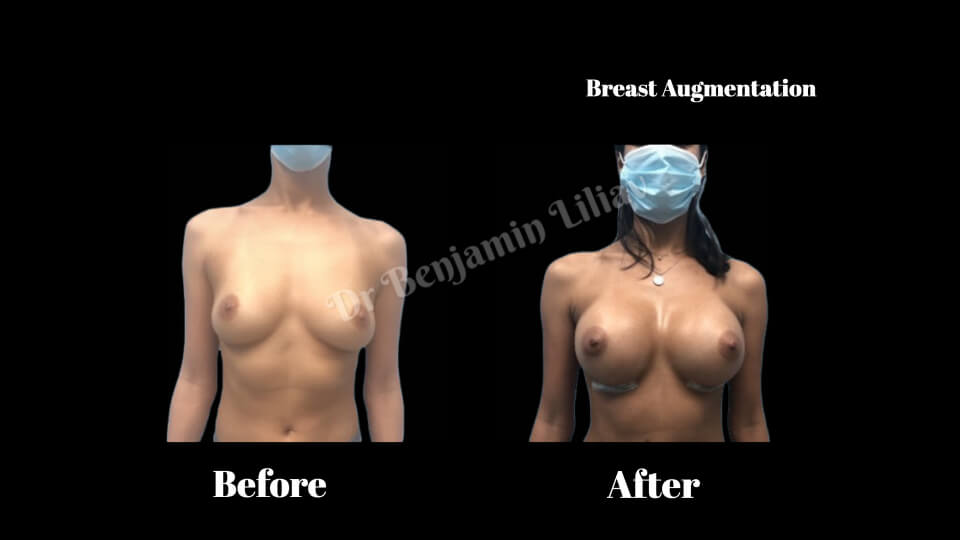 Case--2022 | Before and After Breast Augmentation