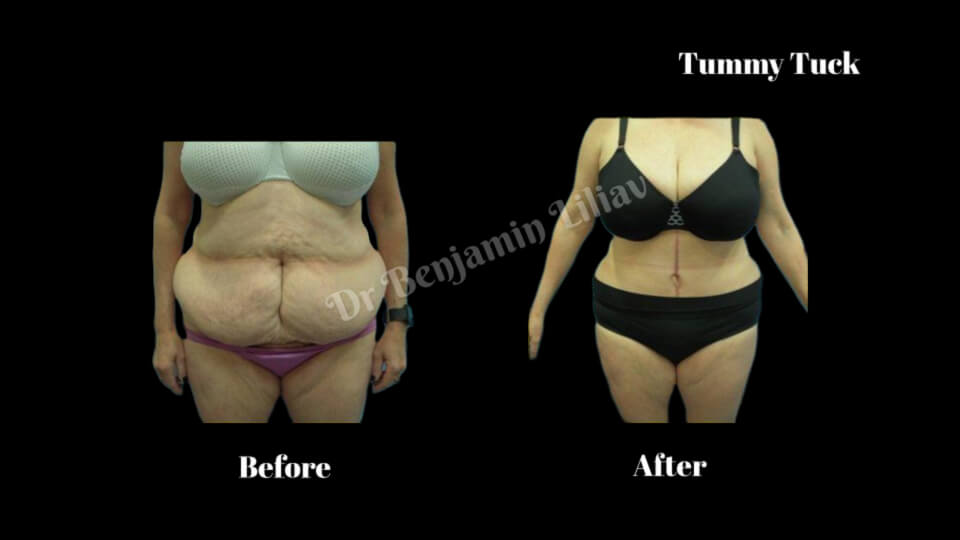 Case--6820 | Before and After Tummy Tuck