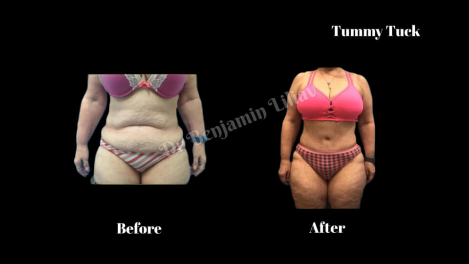 Case--4963 | Before and After Tummy Tuck