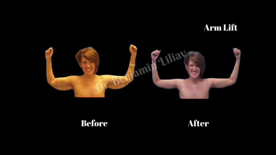 Case--7368 | Before and After Arm Lift