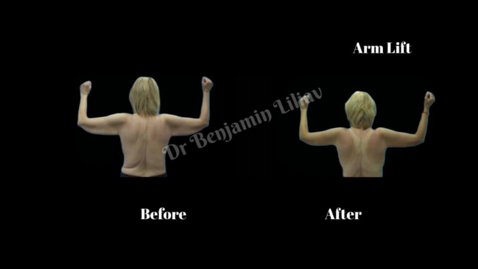 Case--4476 | Before and After Arm Lift