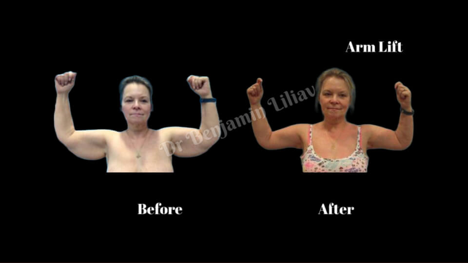 Case--2208 | Before and After Arm Lift