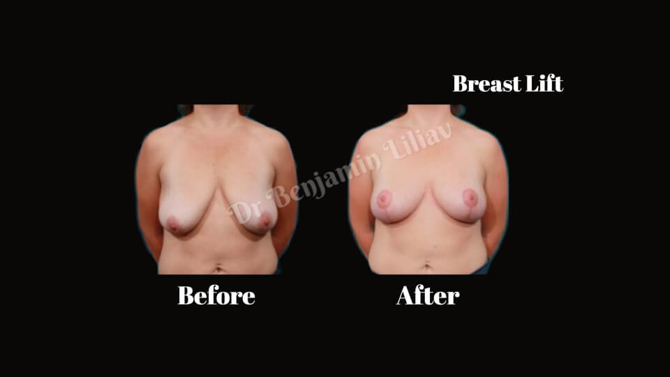 Case--5843 | Before and After Breast