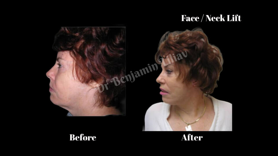 Case--1722 | Before and After Face