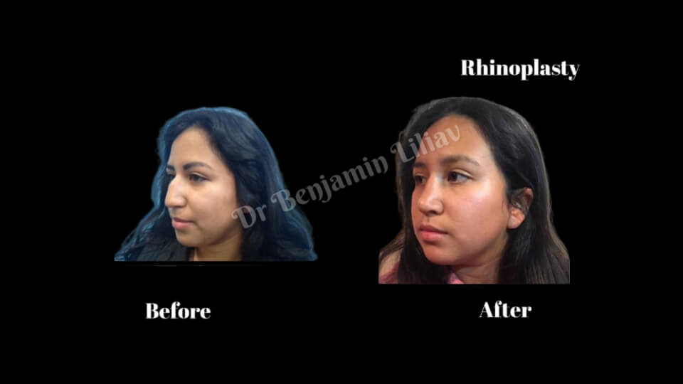 Case--2419 | Before and After Rhinoplasty