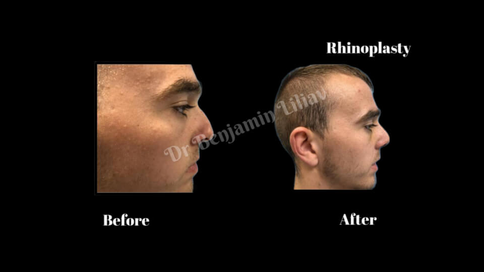 Case--2533 | Before and After Rhinoplasty