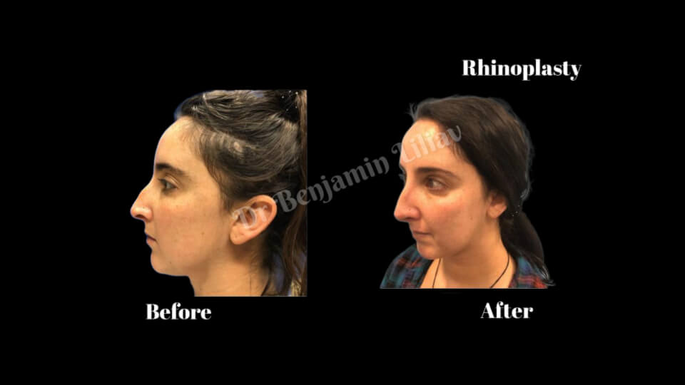 Case--5290 | Before and After Rhinoplasty