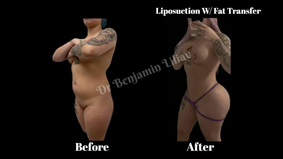 Case--2467 | Before and After BBL