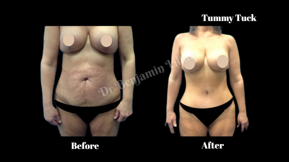 Case--2946 | Before and After Body