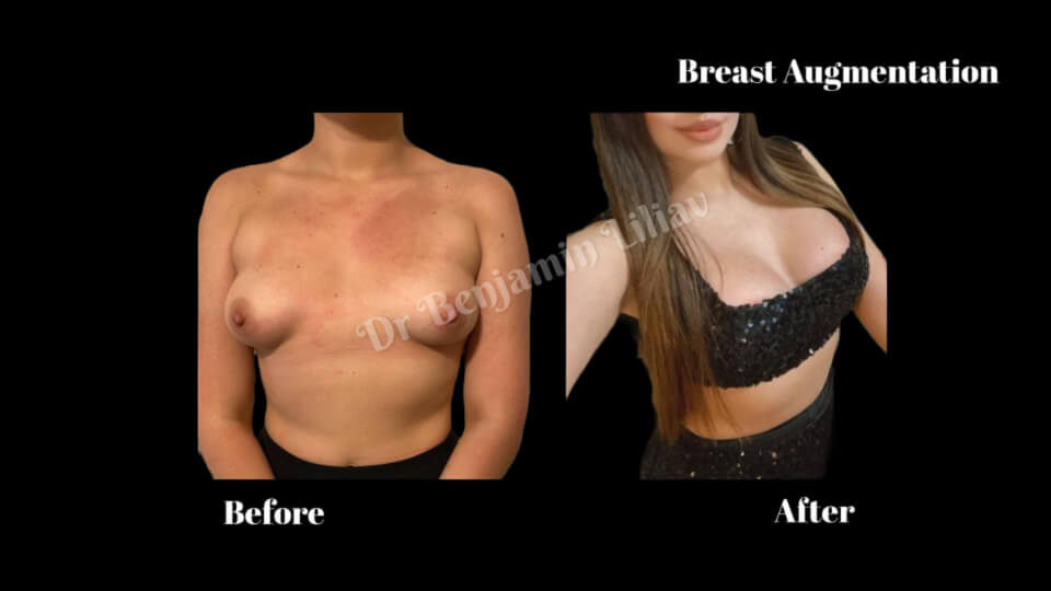 Case--7773 | Before and After Breast Augmentation