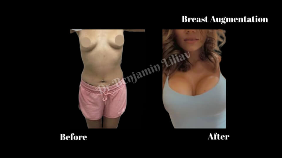 Case--7843 | Before and After Breast Augmentation